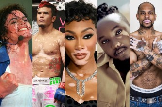 Harimo Umunyarwanda! Ibyamamare 20 byibasiwe n’indwara y’Ibibara “Vitiligo” - AMAFOTO